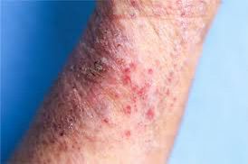 João Pessoa recebe ação da Atópicos Brasil sobre dermatite atópica grave no dia 23 de abril